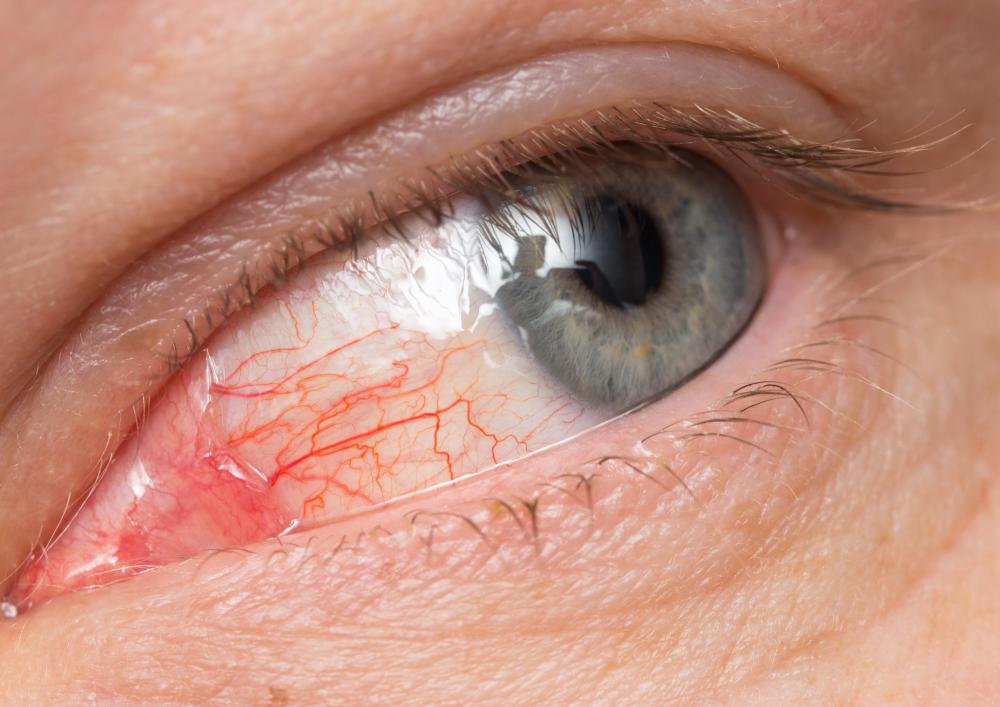 Eye infections may cause epiphora.