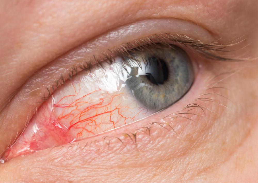 Sewer gas can cause eye irritation.
