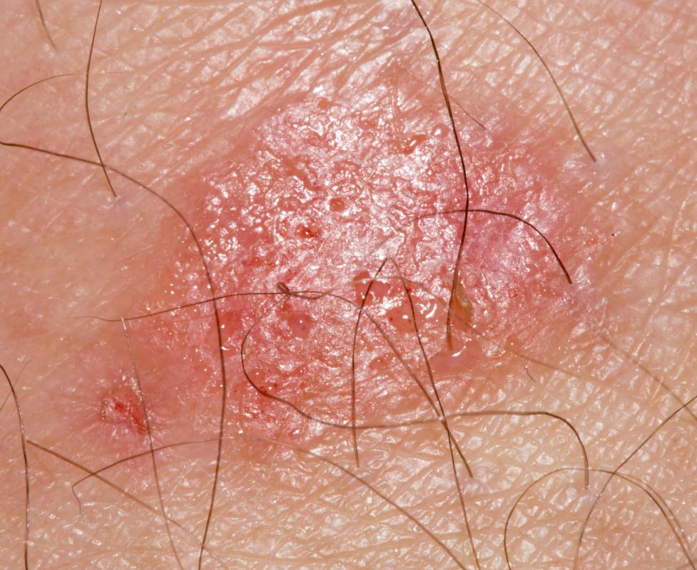 Doctors from India often prescribed Boswellia for ringworm.