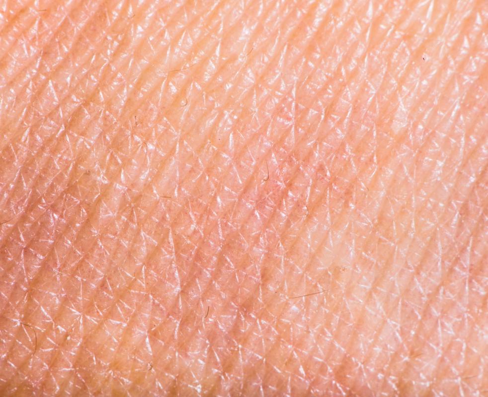 Scabies is caused by the microscopic organism sacoptes scabiei which burrows underneath the skin to deposit its eggs.