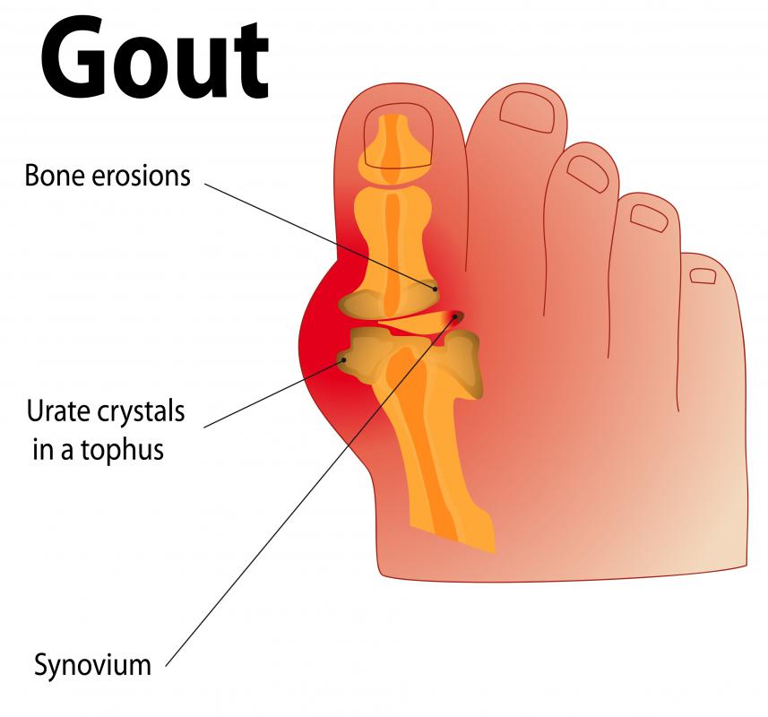 Nettle has been used for centuries as a herbal treatment for gout.