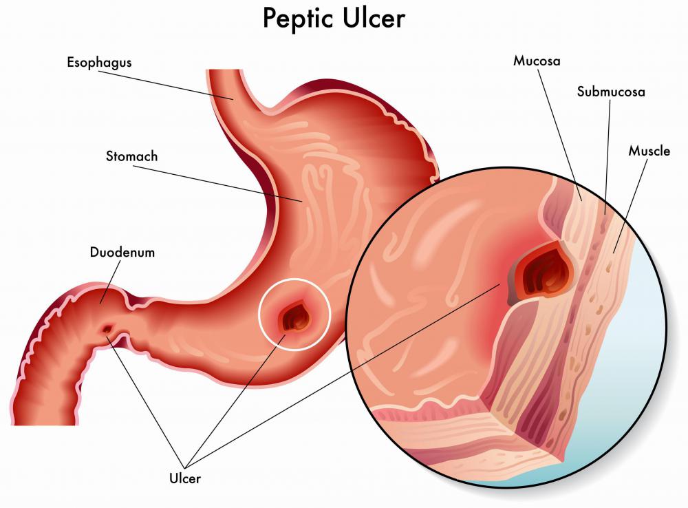 Boswellia may be helpful in treating ulcers.