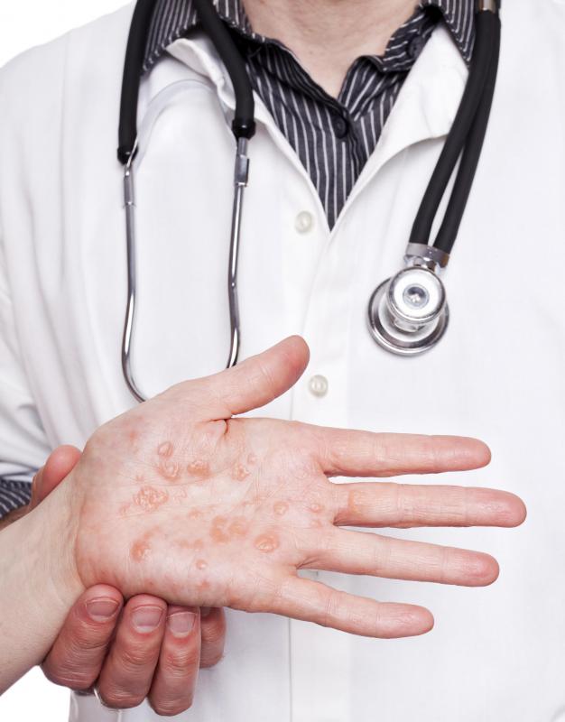 Individuals who are allergic to wasp stings may experience hives.
