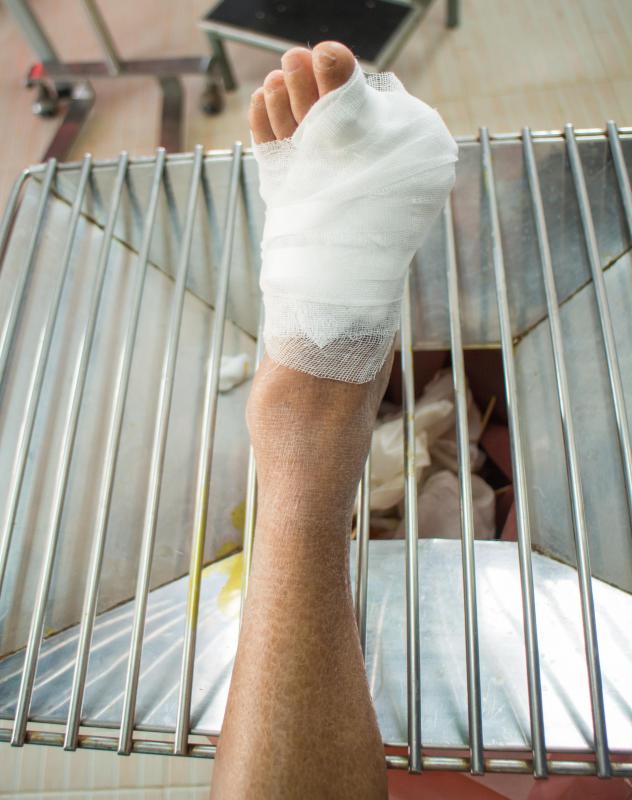Frostbitten toes may require amputation in extreme cases.
