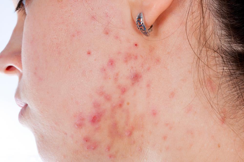 Witch hazel may help manage acne breakouts.