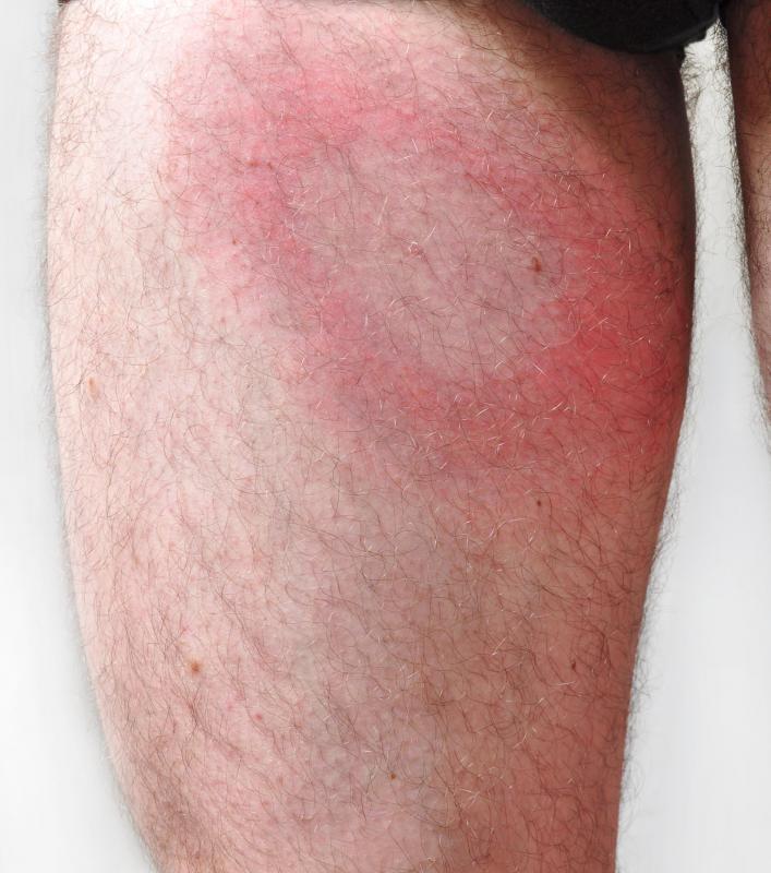 Humans infected with Lyme disease will get a ringed rash at the site of the tick bite.
