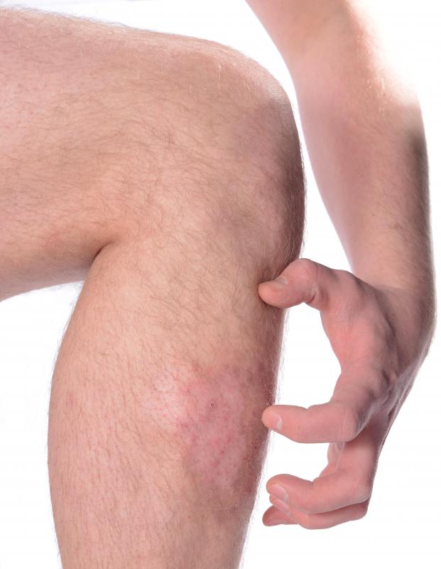 Scabies mites cause a rash to form that can be itchy.