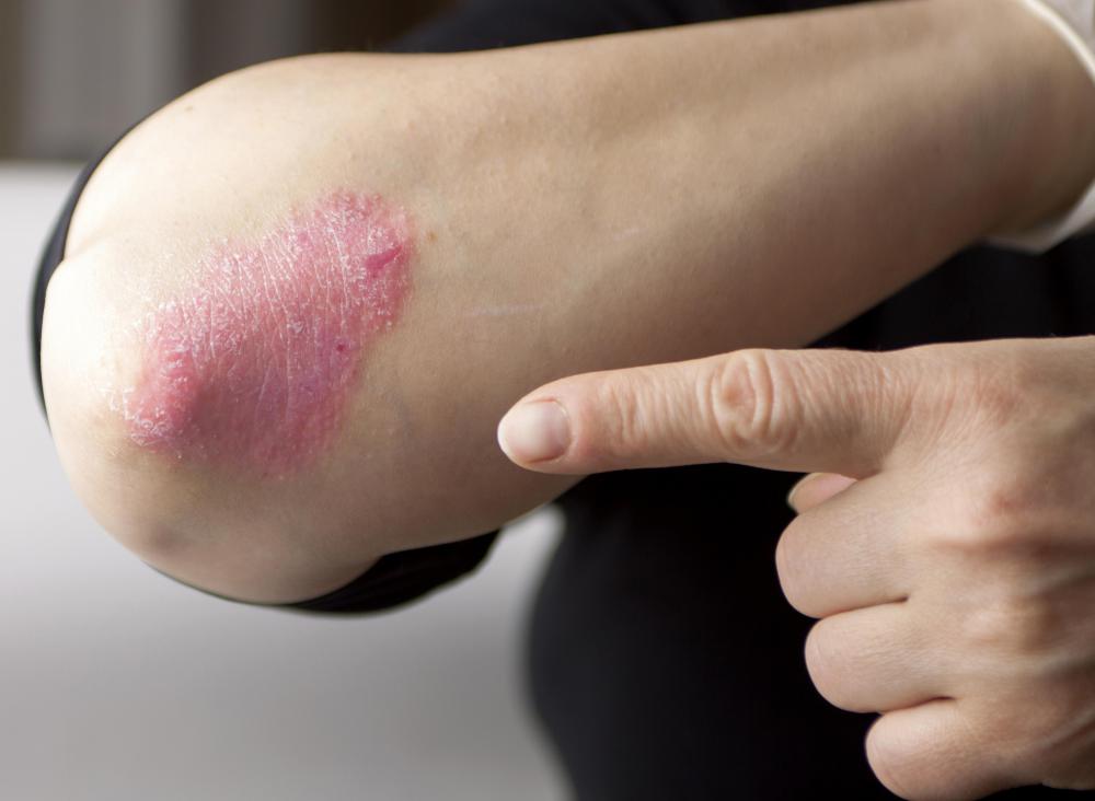 Fish therapy may be beneficial for people suffering from psoriasis.