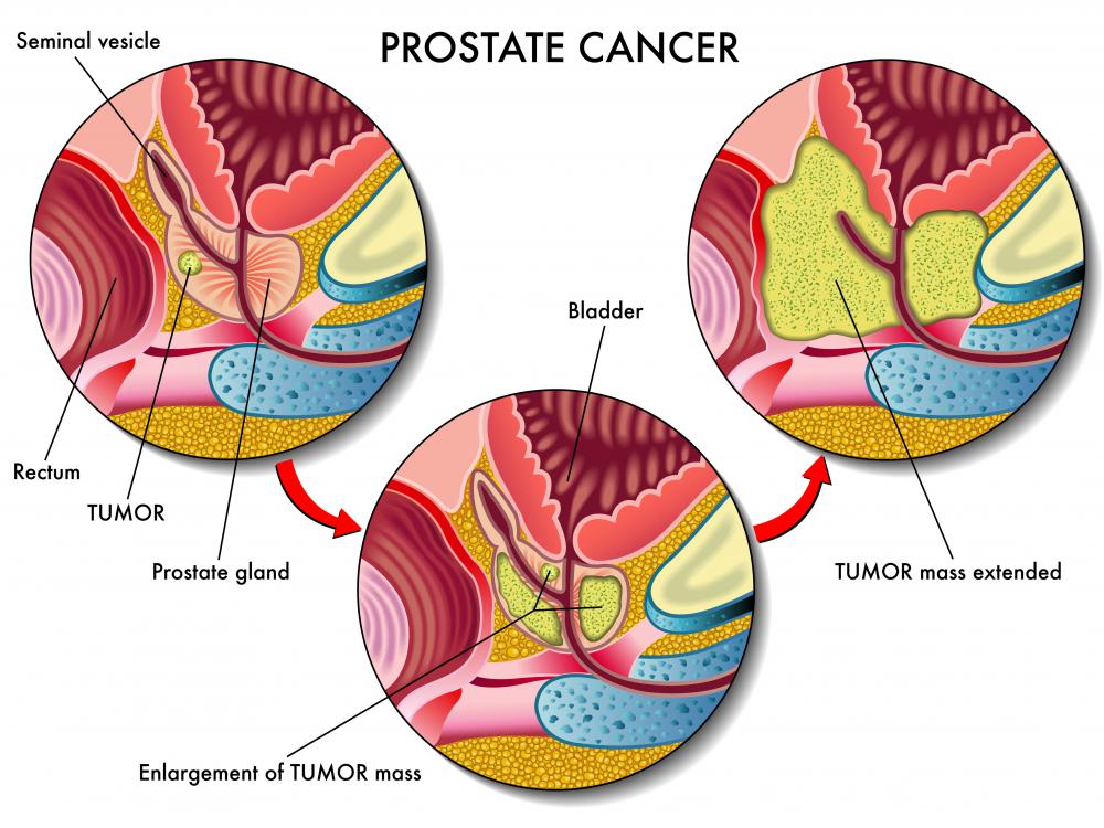 Research on cancer prevention with menadione shows promise in future treatment strategies for prostate cancers.