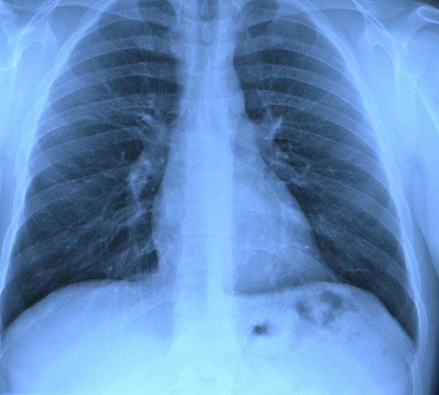 Silica sand exposure has been linked to lung cancer.