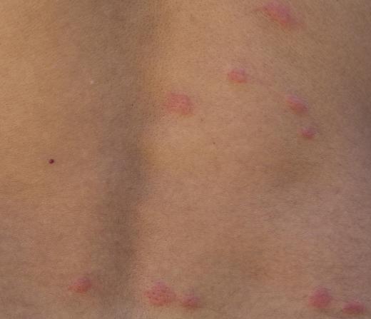 Sand flea bites can cause reddish colored welts.