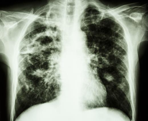 Mycobacterium smegmatis is used to develop and test treatments for tuberculosis.